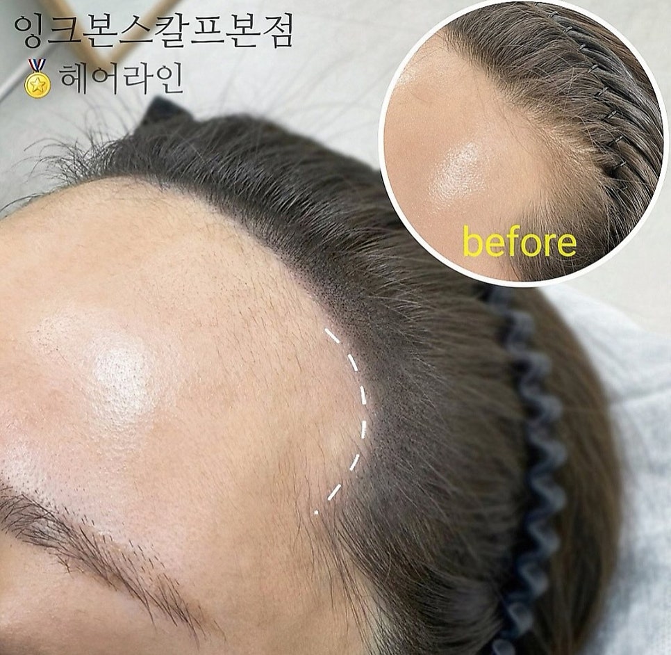 두피문신 작업