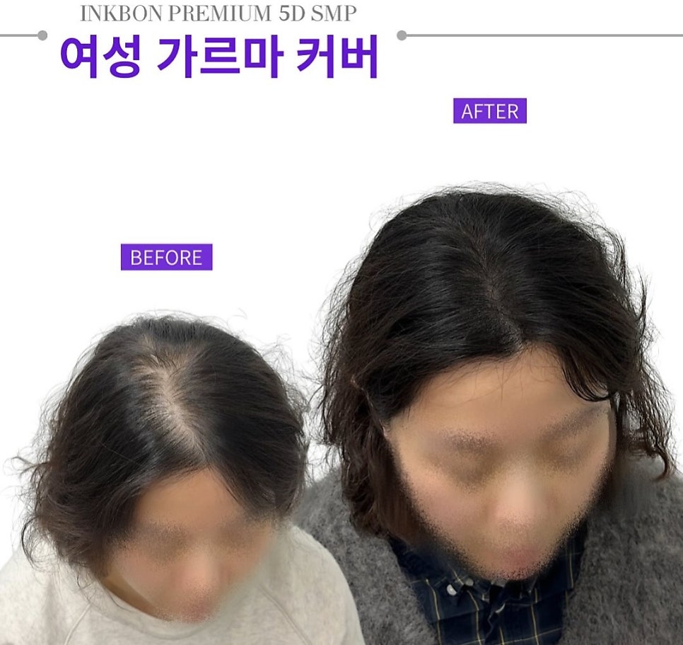 두피문신 작업