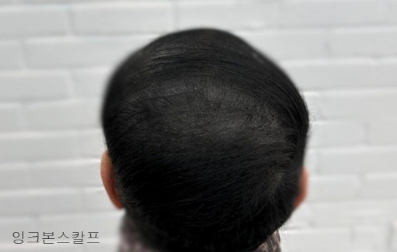 두피문신 작업