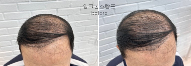 두피문신 작업
