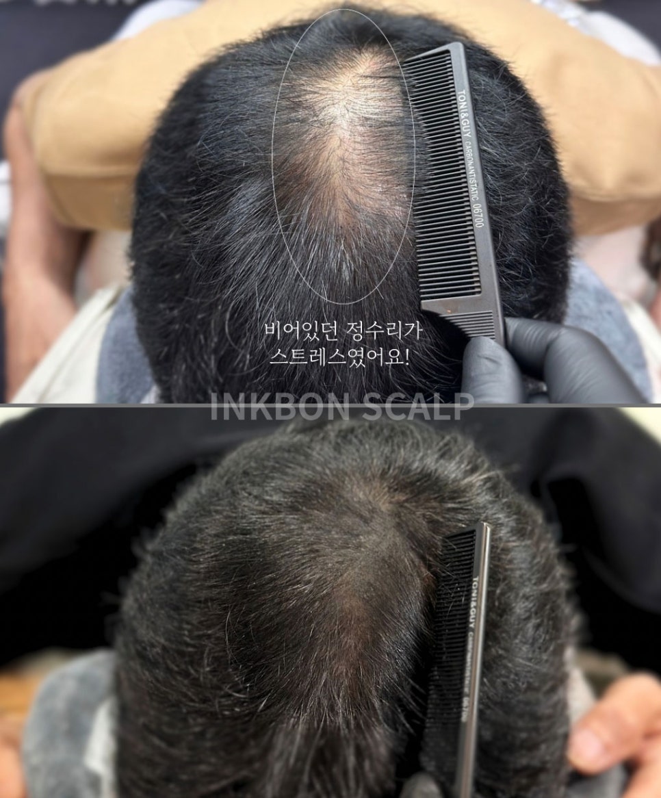 두피문신 작업