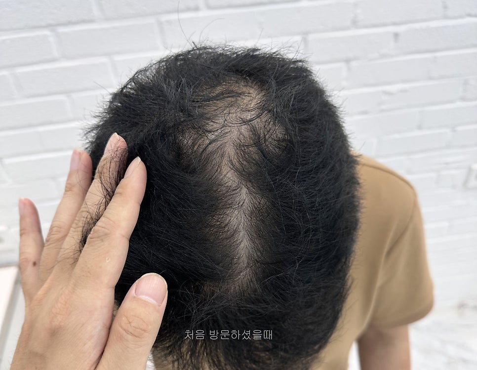 두피문신 작업